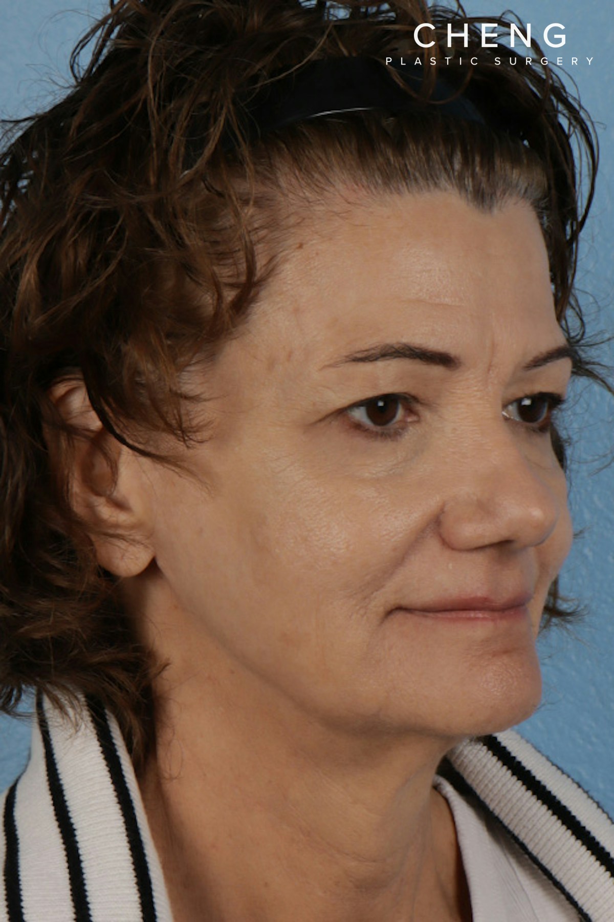 Pigment Laser Before & After Gallery - Patient 374844 - Image 4