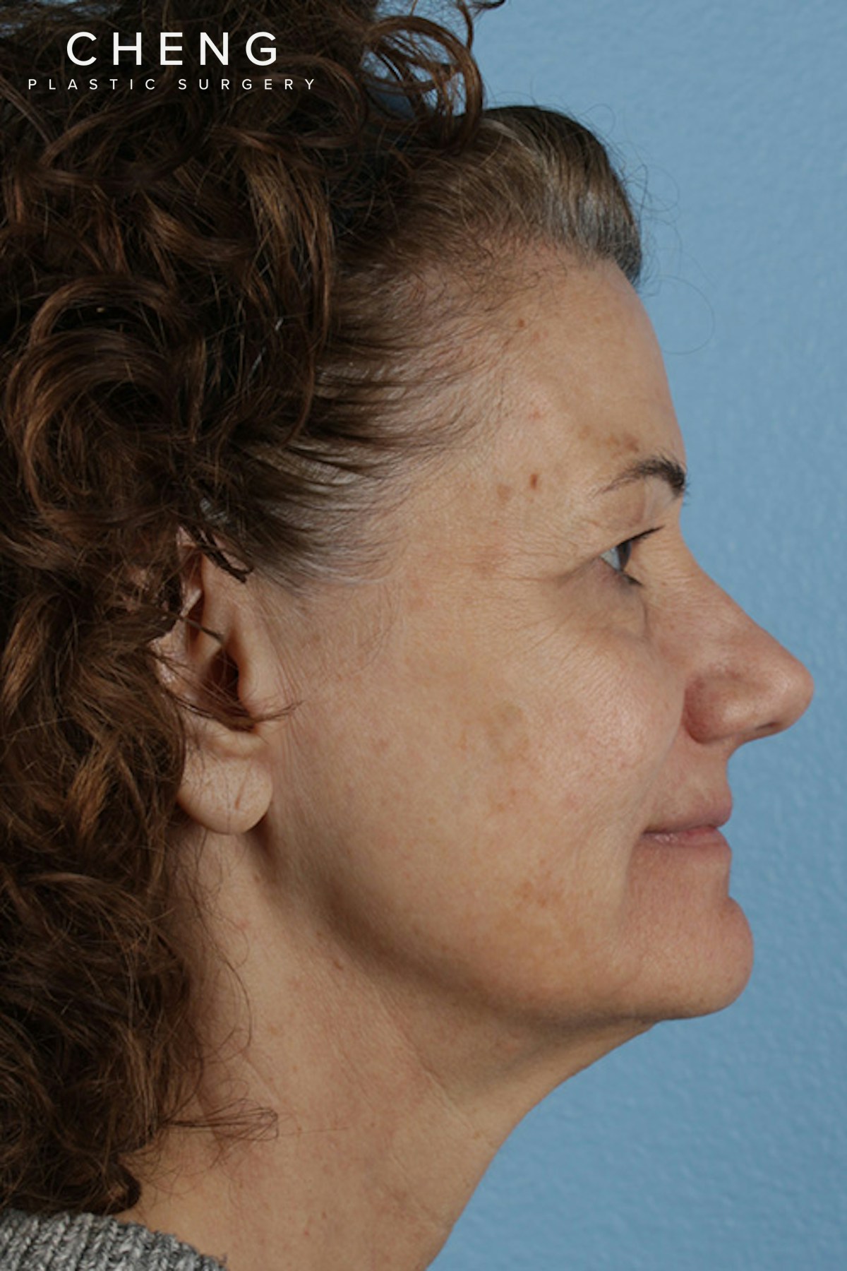 Pigment Laser Before & After Gallery - Patient 374844 - Image 5