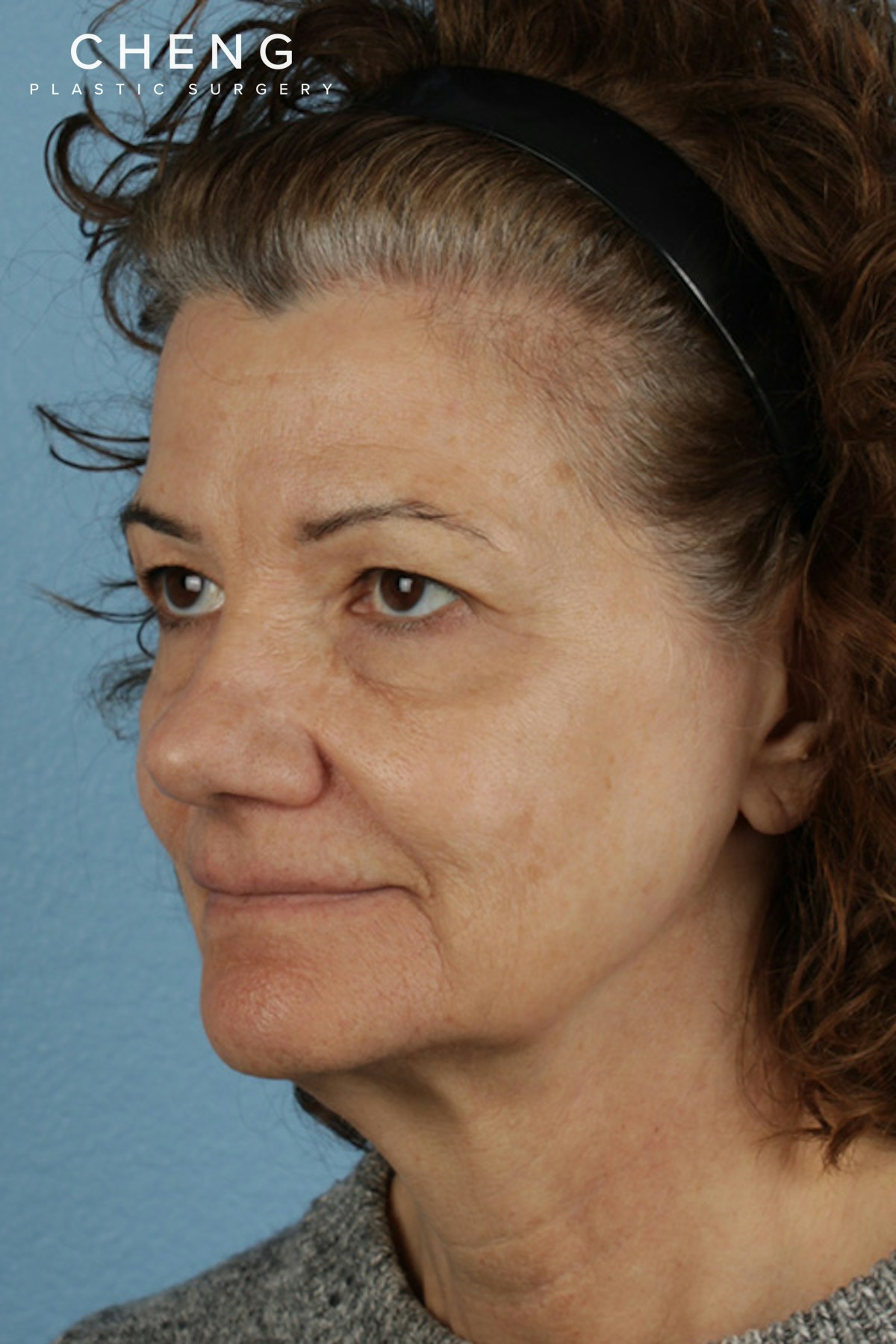 Pigment Laser Before & After Gallery - Patient 374844 - Image 7