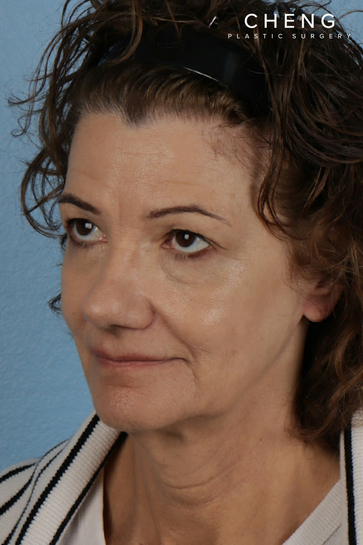 Pigment Laser Before & After Gallery - Patient 374844 - Image 8