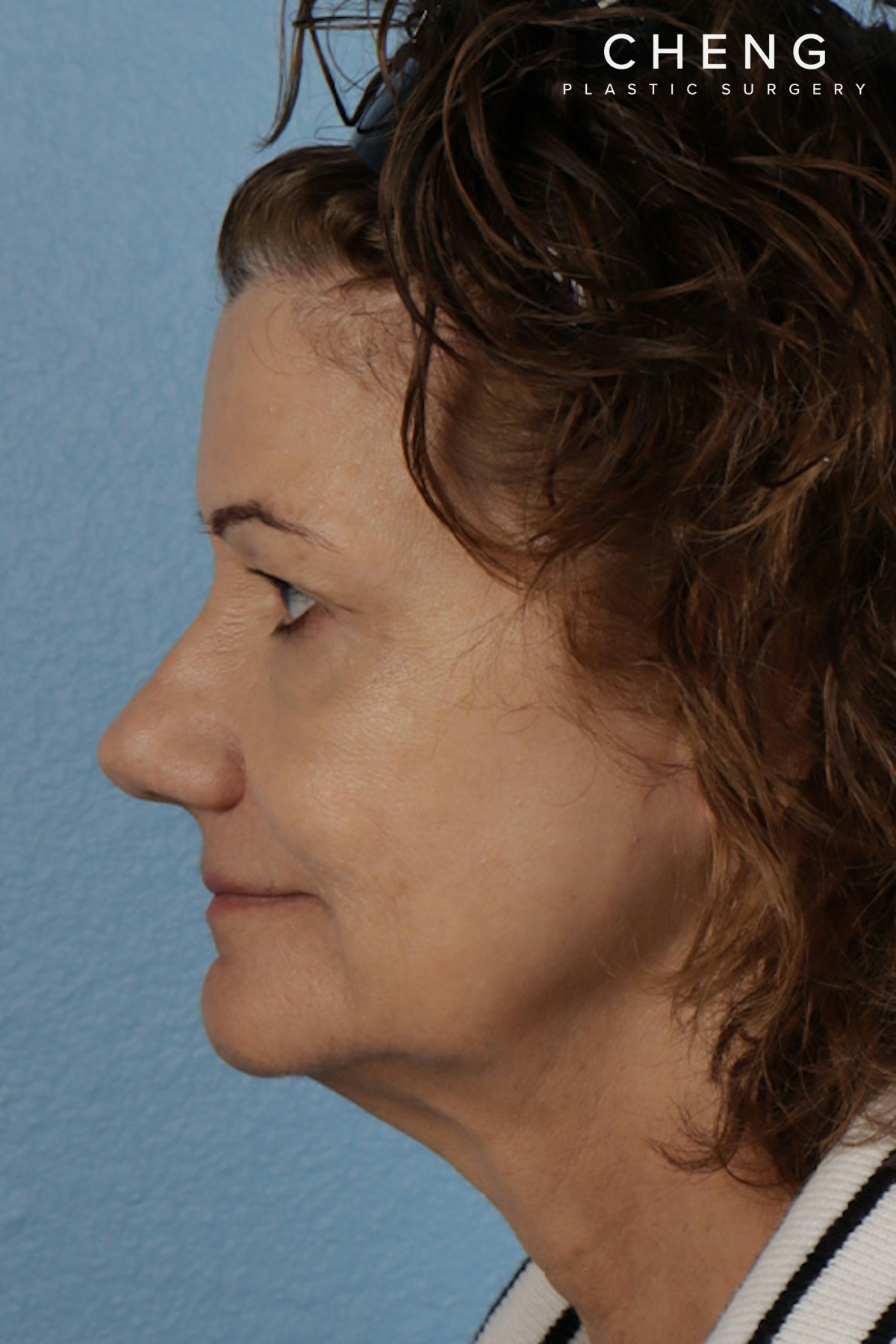 Pigment Laser Before & After Gallery - Patient 374844 - Image 10