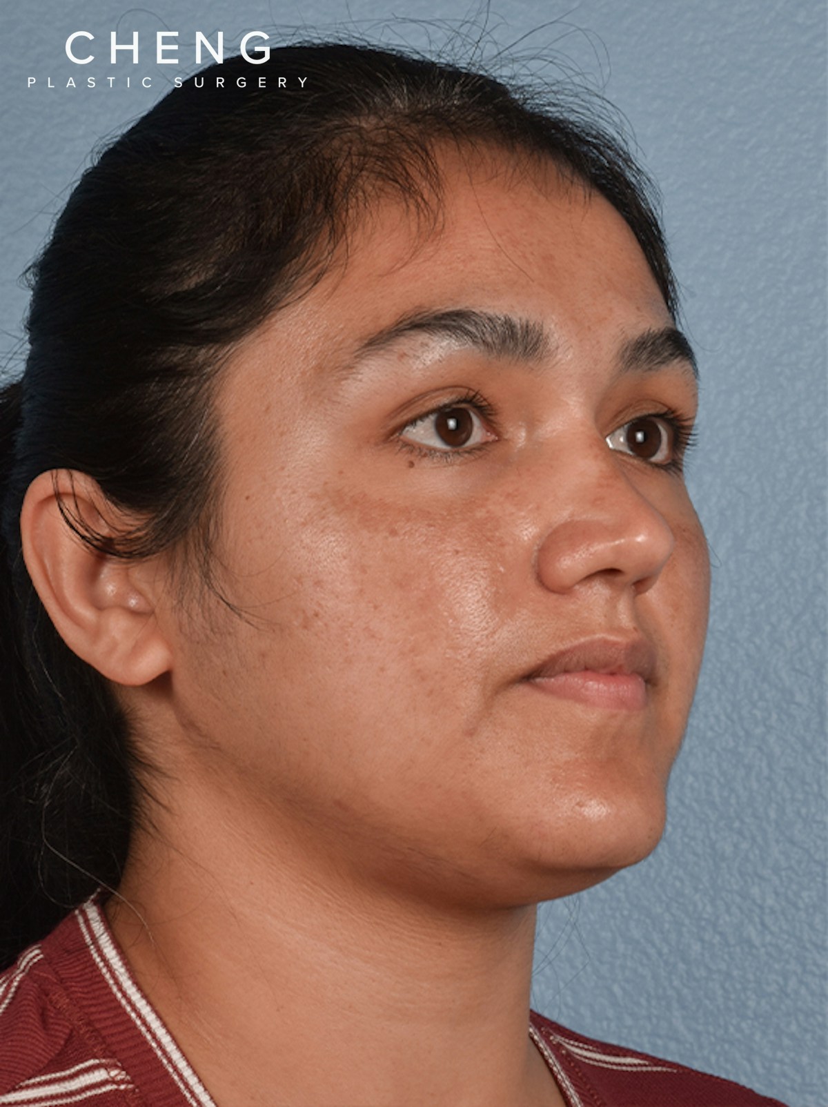 Hidden Patients Before & After Gallery - Patient 178995 - Image 5