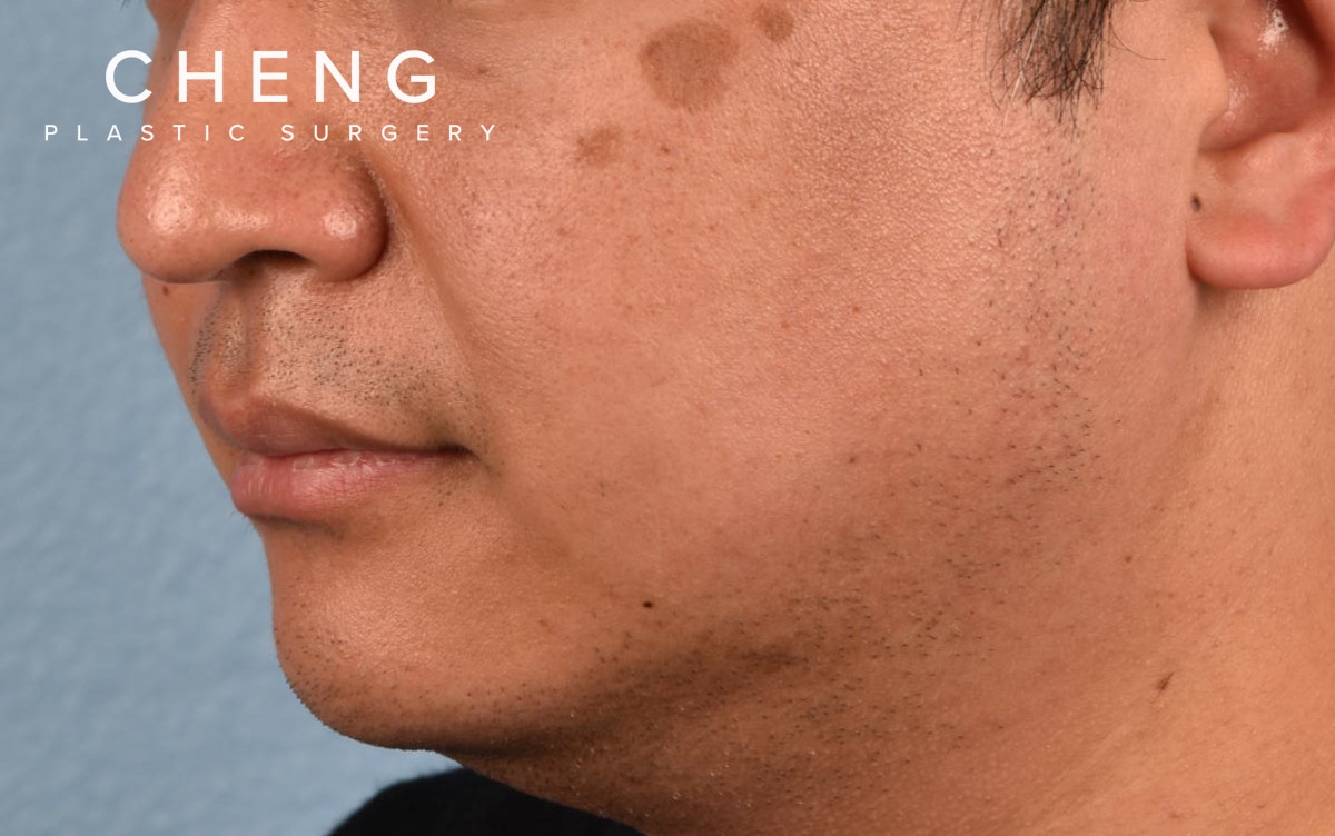 Pigment Laser Before & After Gallery - Patient 266397 - Image 1