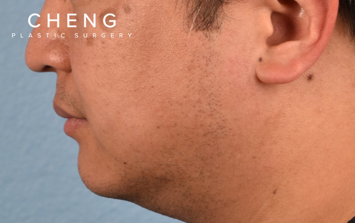 Pigment Laser Before & After Gallery - Patient 266397 - Image 3