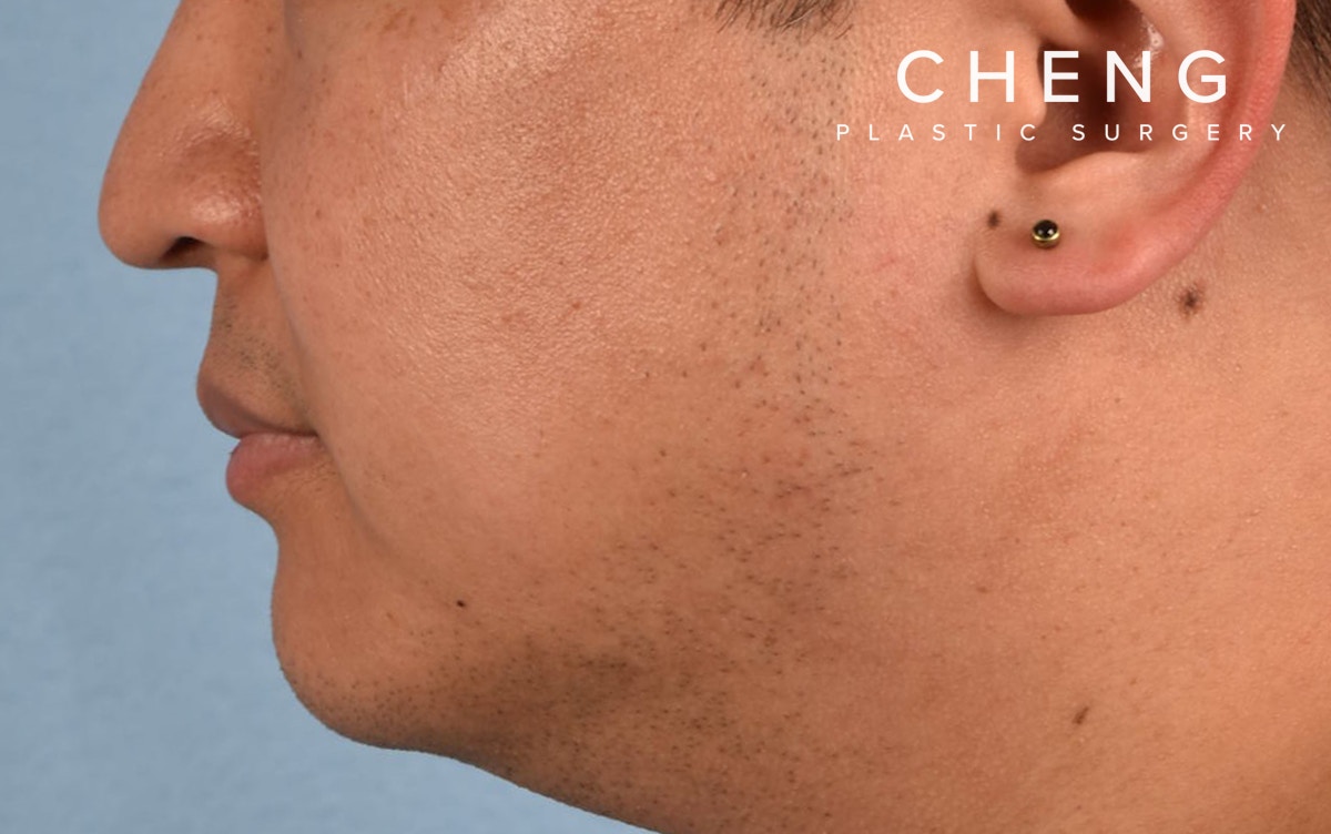 Pigment Laser Before & After Gallery - Patient 266397 - Image 4