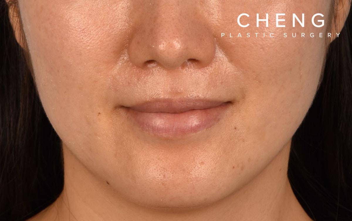 Pigment Laser Before & After Gallery - Patient 230352 - Image 2