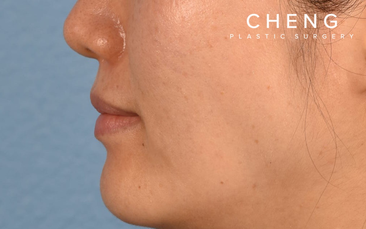 Pigment Laser Before & After Gallery - Patient 230352 - Image 4