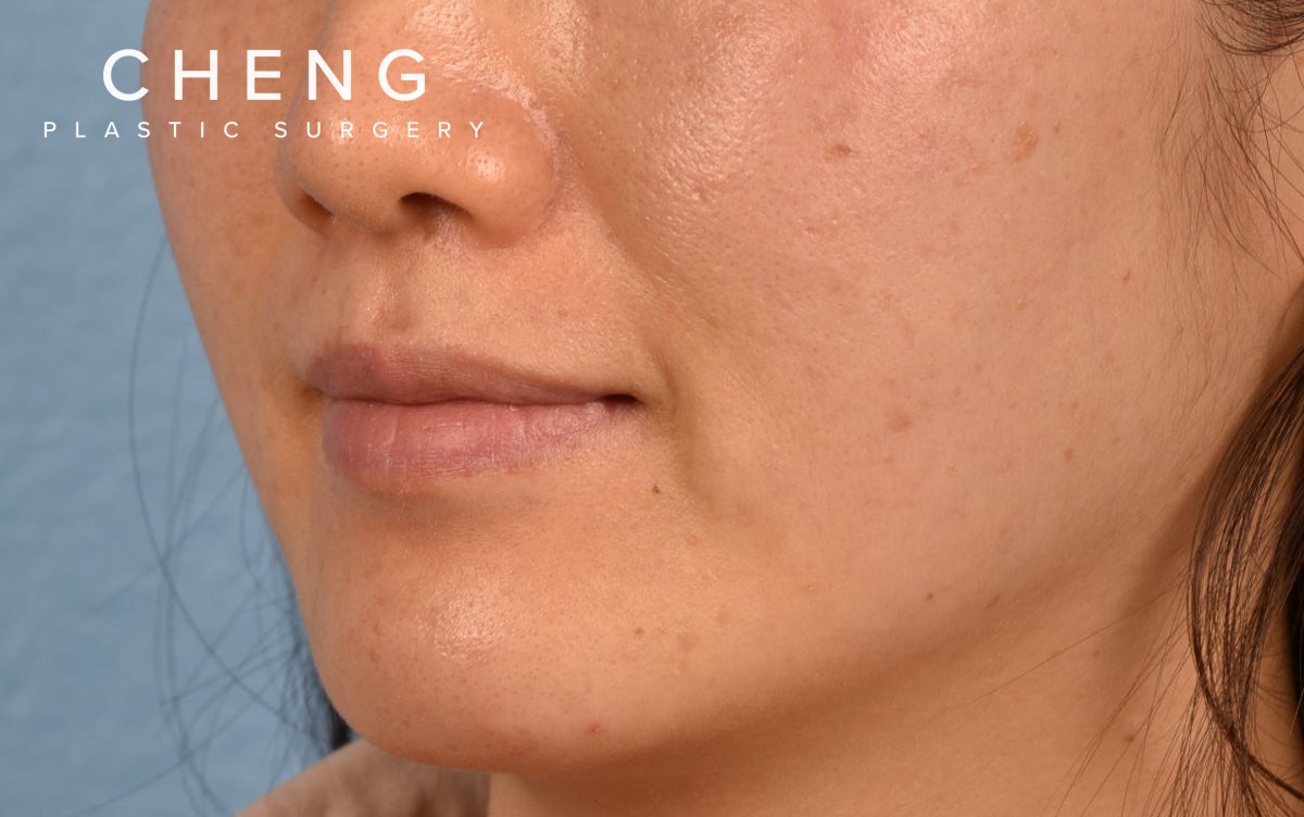 Pigment Laser Before & After Gallery - Patient 230352 - Image 5