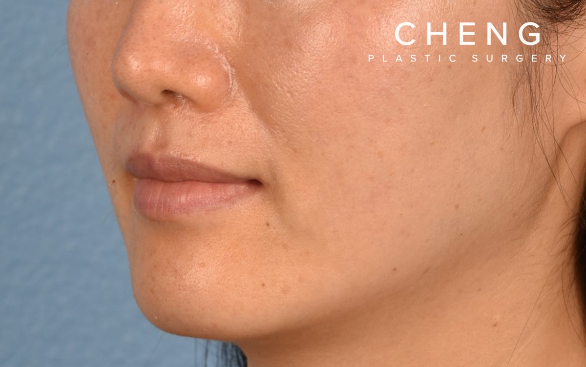 Pigment Laser Before & After Gallery - Patient 230352 - Image 6