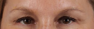 Hidden Patients Before & After Gallery - Patient 283134 - Image 2