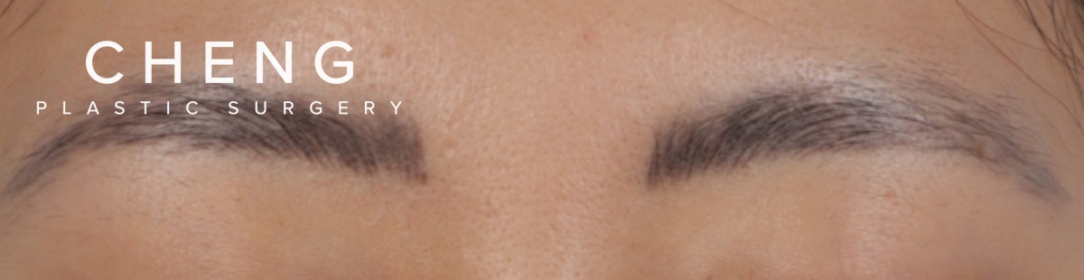 Brow Tattoo Removal Before & After Gallery - Patient 742306 - Image 1