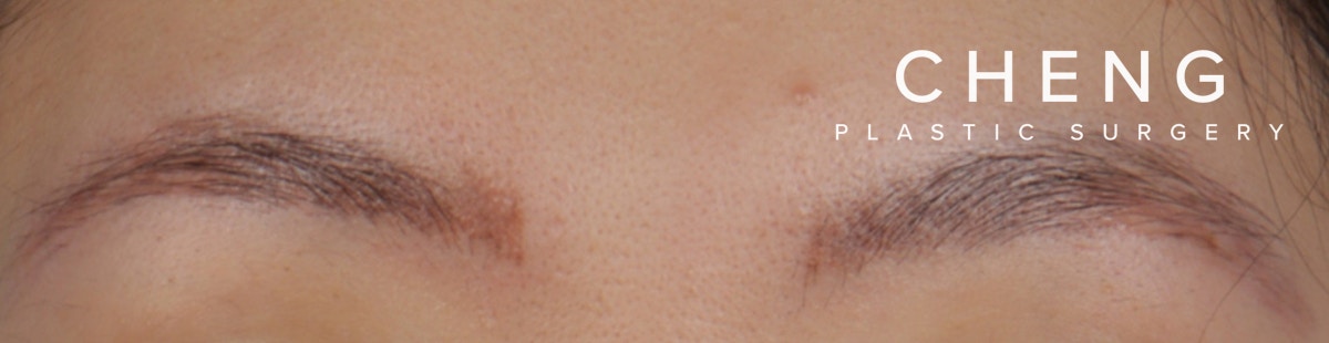 Brow Tattoo Removal Before & After Gallery - Patient 742306 - Image 2