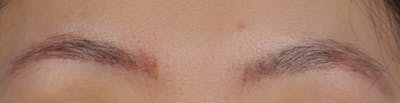 Brow Tattoo Removal Before & After Gallery - Patient 742306 - Image 2