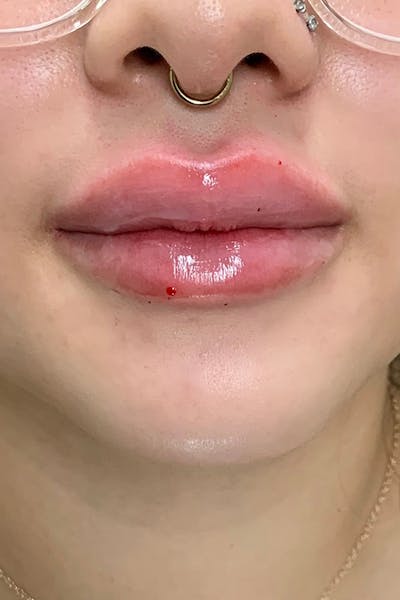 Hidden Patients Before & After Gallery - Patient 405070 - Image 2