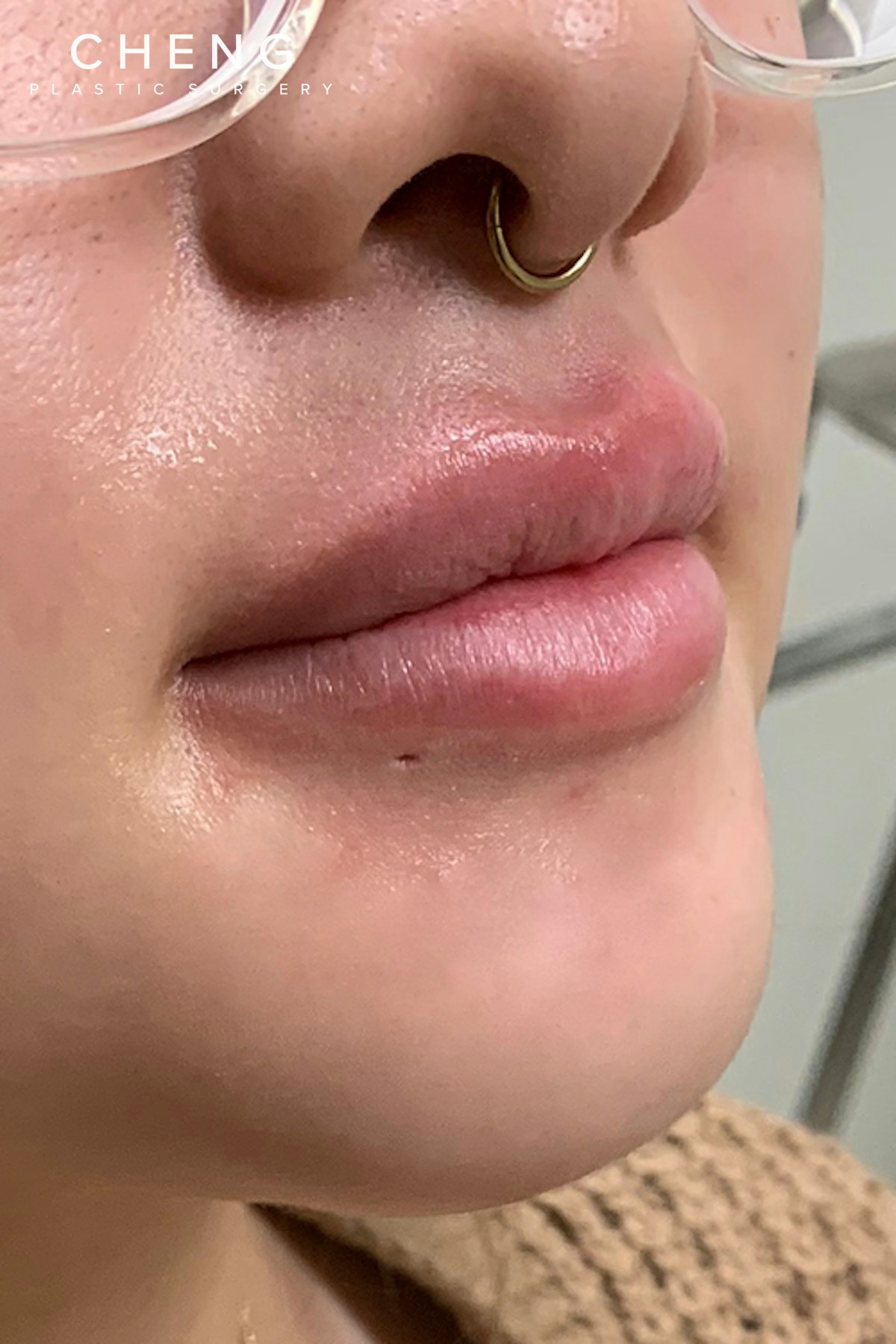 Hidden Patients Before & After Gallery - Patient 405070 - Image 3
