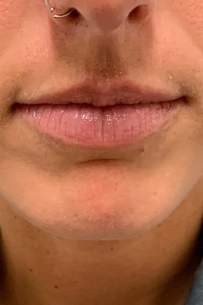 Dermal Fillers Before & After Gallery - Patient 162258 - Image 1