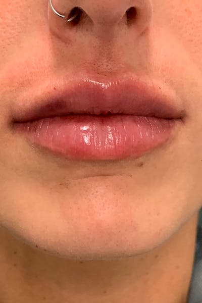 Dermal Fillers Before & After Gallery - Patient 162258 - Image 2