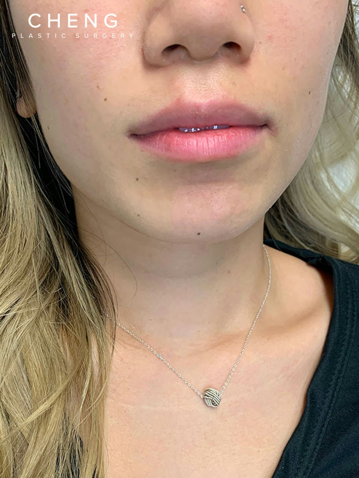 Dermal Fillers Before & After Gallery - Patient 496630 - Image 1