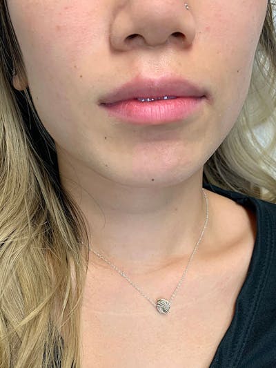 Dermal Fillers Before & After Gallery - Patient 496630 - Image 1
