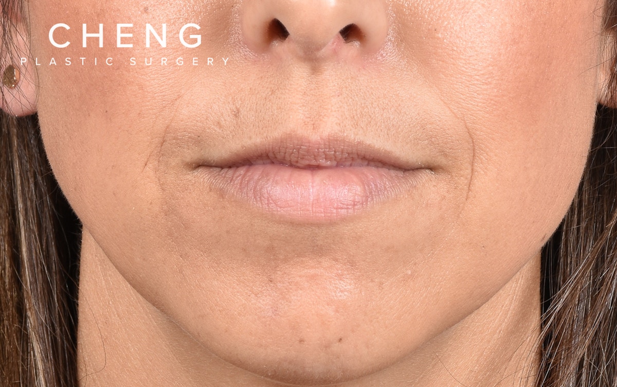 Dermal Fillers Before & After Gallery - Patient 572156 - Image 1