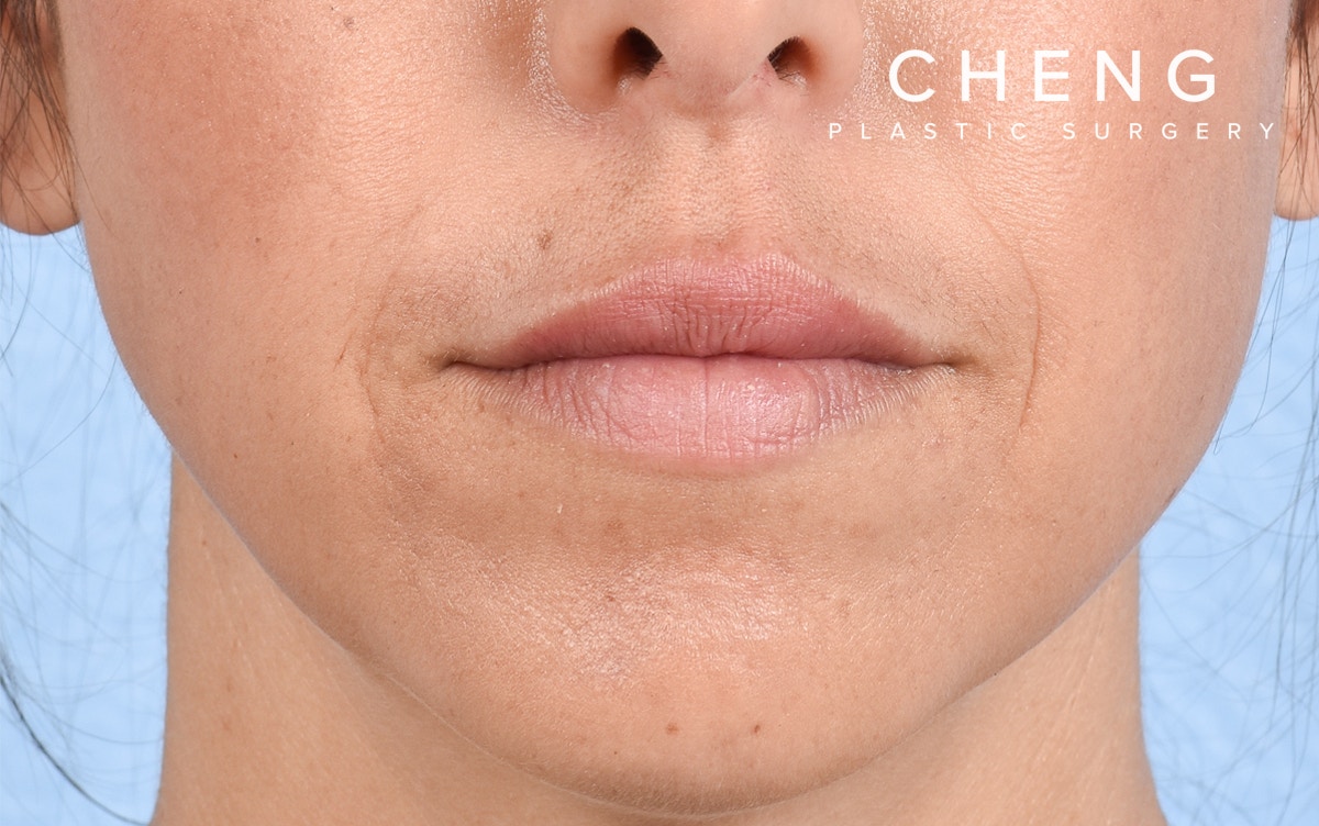 Dermal Fillers Before & After Gallery - Patient 572156 - Image 2