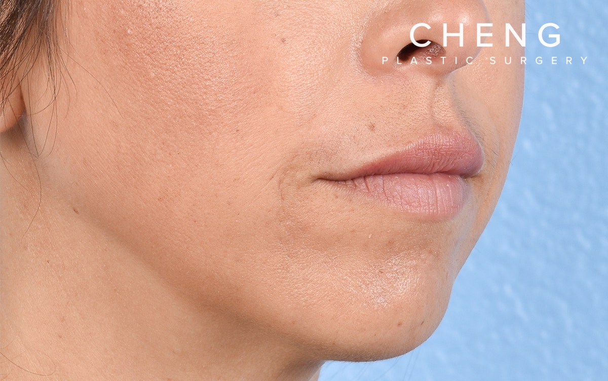 Dermal Fillers Before & After Gallery - Patient 572156 - Image 4