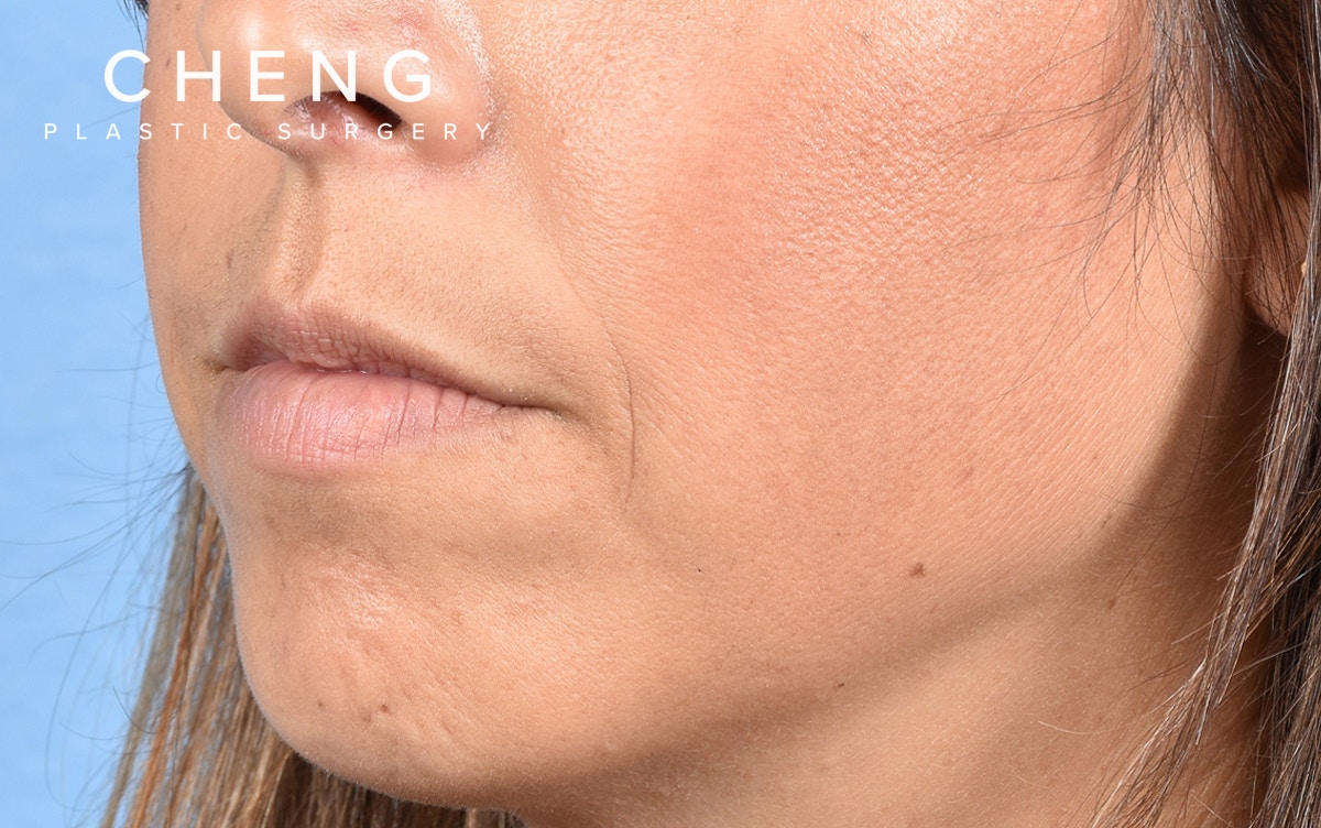 Dermal Fillers Before & After Gallery - Patient 572156 - Image 5