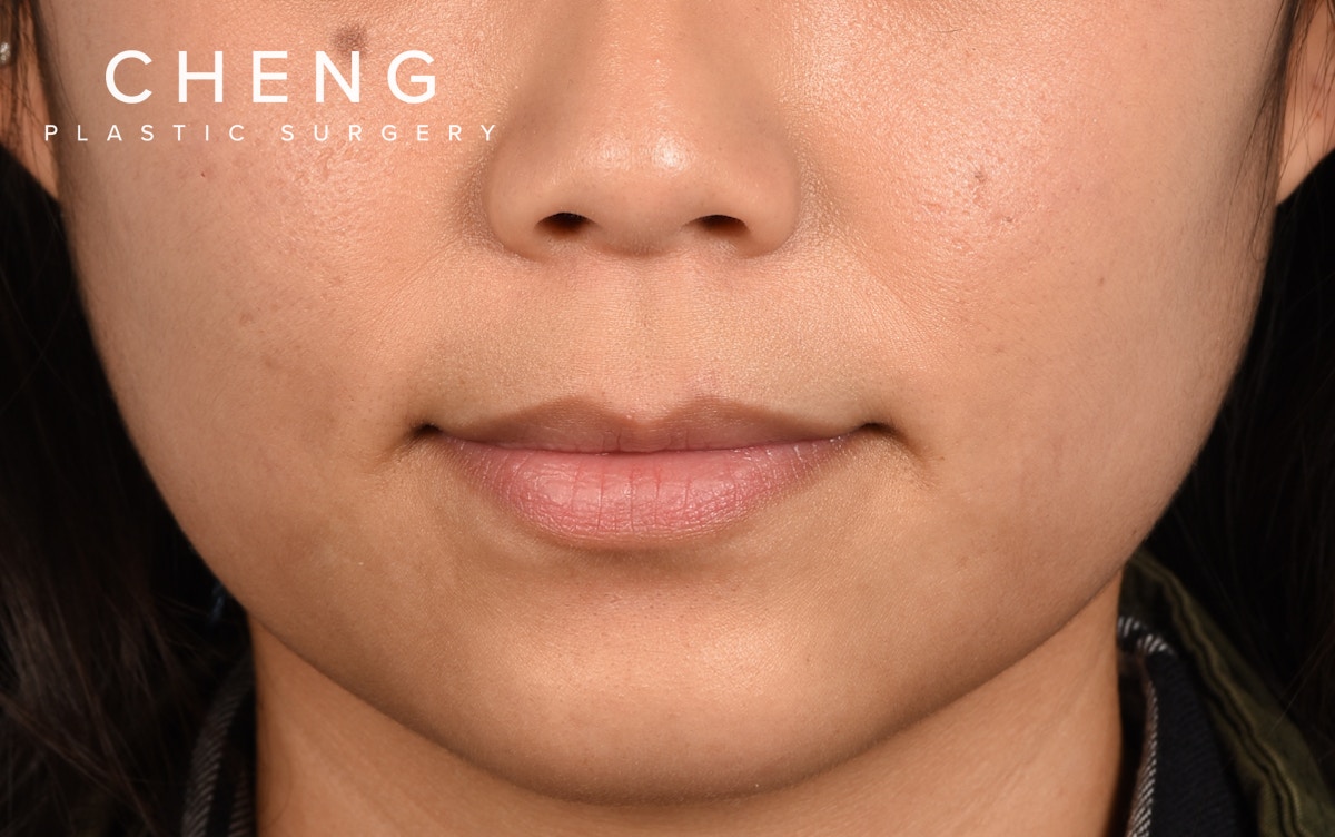 Dermal Fillers Before & After Gallery - Patient 720528 - Image 1