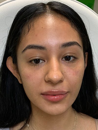 Hidden Patients Before & After Gallery - Patient 105891 - Image 2