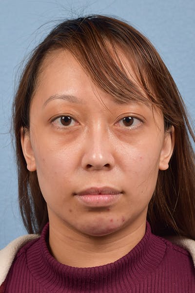 Dermal Fillers Before & After Gallery - Patient 959337 - Image 1