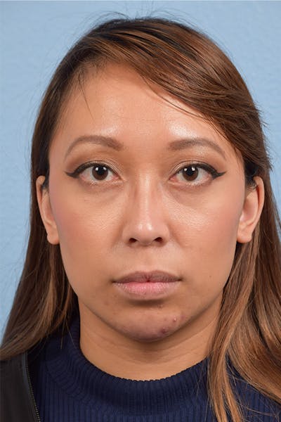 Dermal Fillers Before & After Gallery - Patient 959337 - Image 2