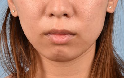 Dermal Fillers Before & After Gallery - Patient 252596 - Image 1