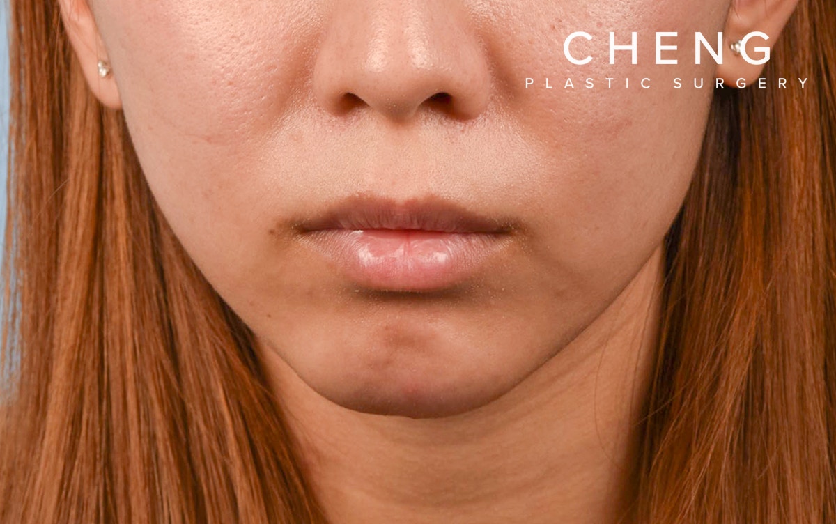 Dermal Fillers Before & After Gallery - Patient 252596 - Image 2