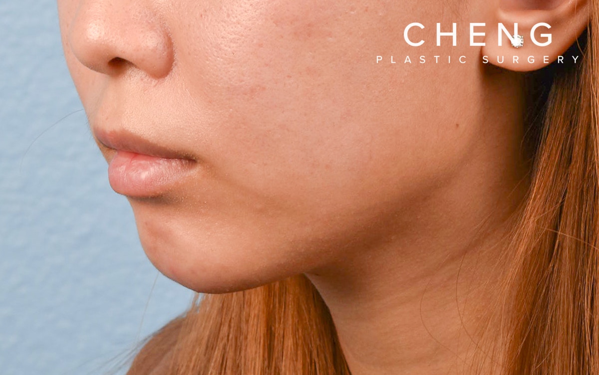 Dermal Fillers Before & After Gallery - Patient 252596 - Image 4
