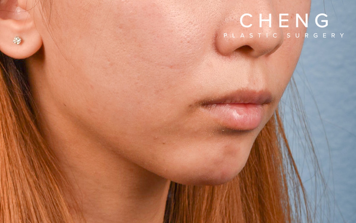 Dermal Fillers Before & After Gallery - Patient 252596 - Image 6