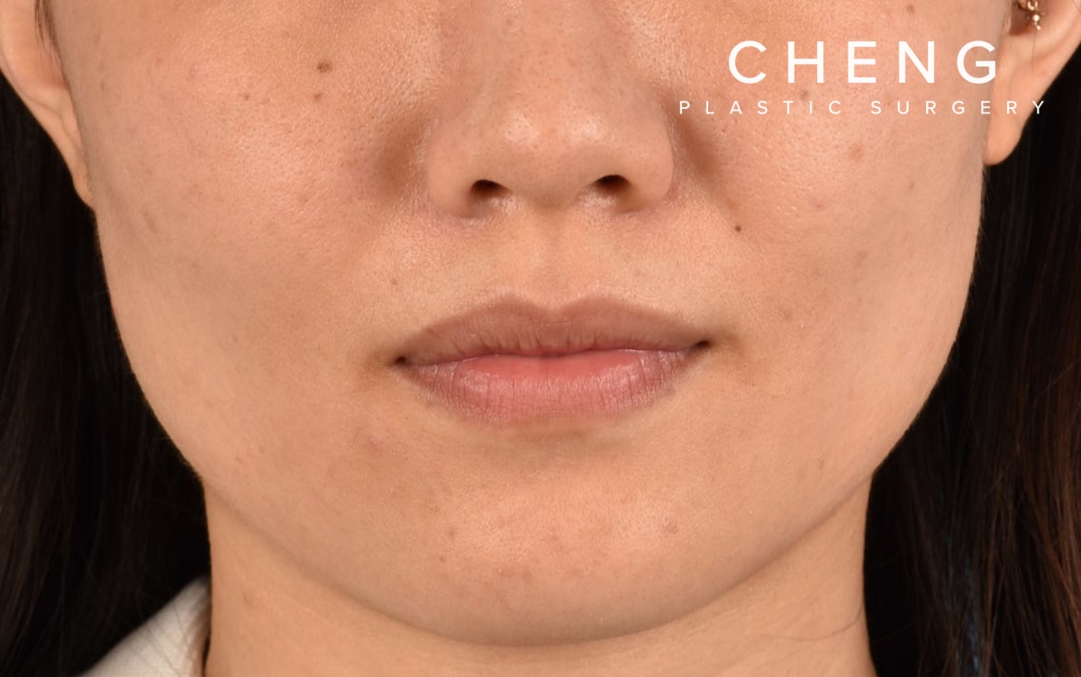 Hidden Patients Before & After Gallery - Patient 349943 - Image 2