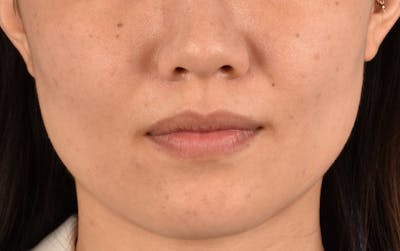 Hidden Patients Before & After Gallery - Patient 349943 - Image 2