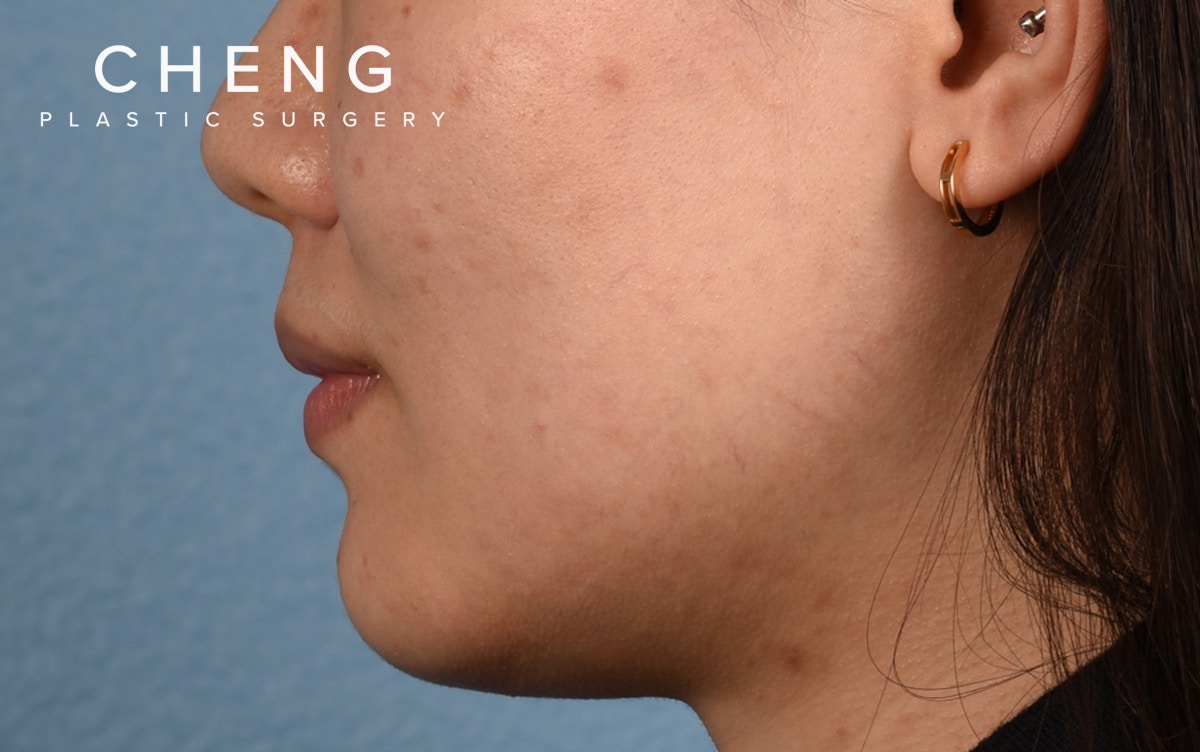 Hidden Patients Before & After Gallery - Patient 349943 - Image 9