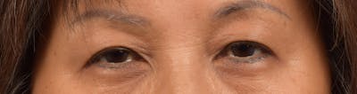 Hidden Patients Before & After Gallery - Patient 947245 - Image 1