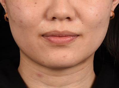 Hidden Patients Before & After Gallery - Patient 146208 - Image 1