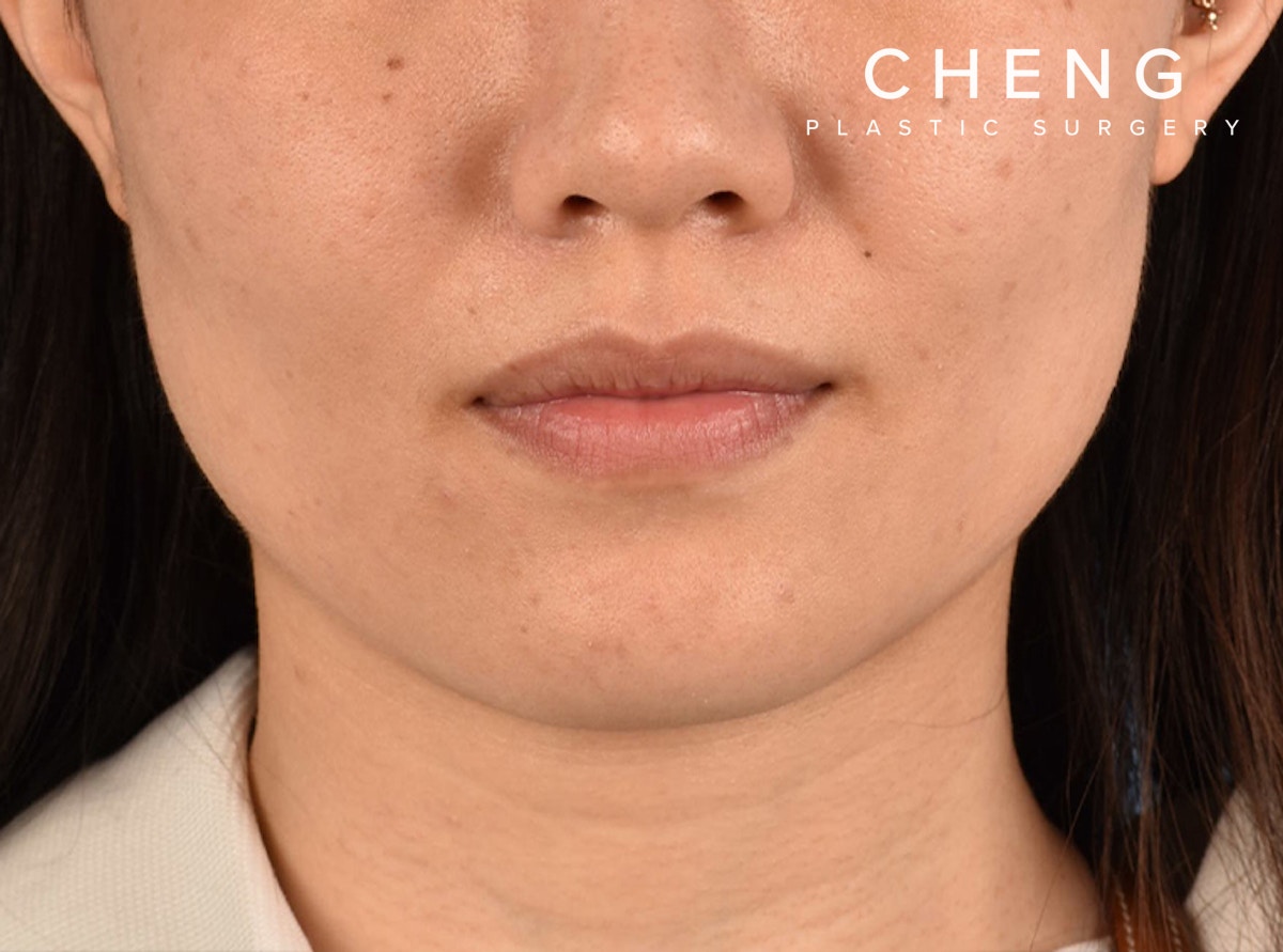 Hidden Patients Before & After Gallery - Patient 146208 - Image 2