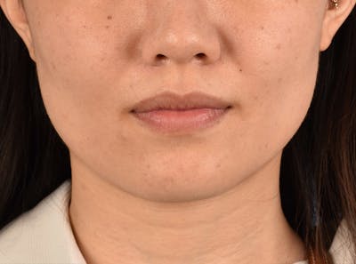 Hidden Patients Before & After Gallery - Patient 146208 - Image 2