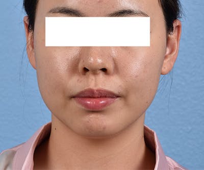 Thermage FLX  Before & After Gallery - Patient 163377 - Image 1