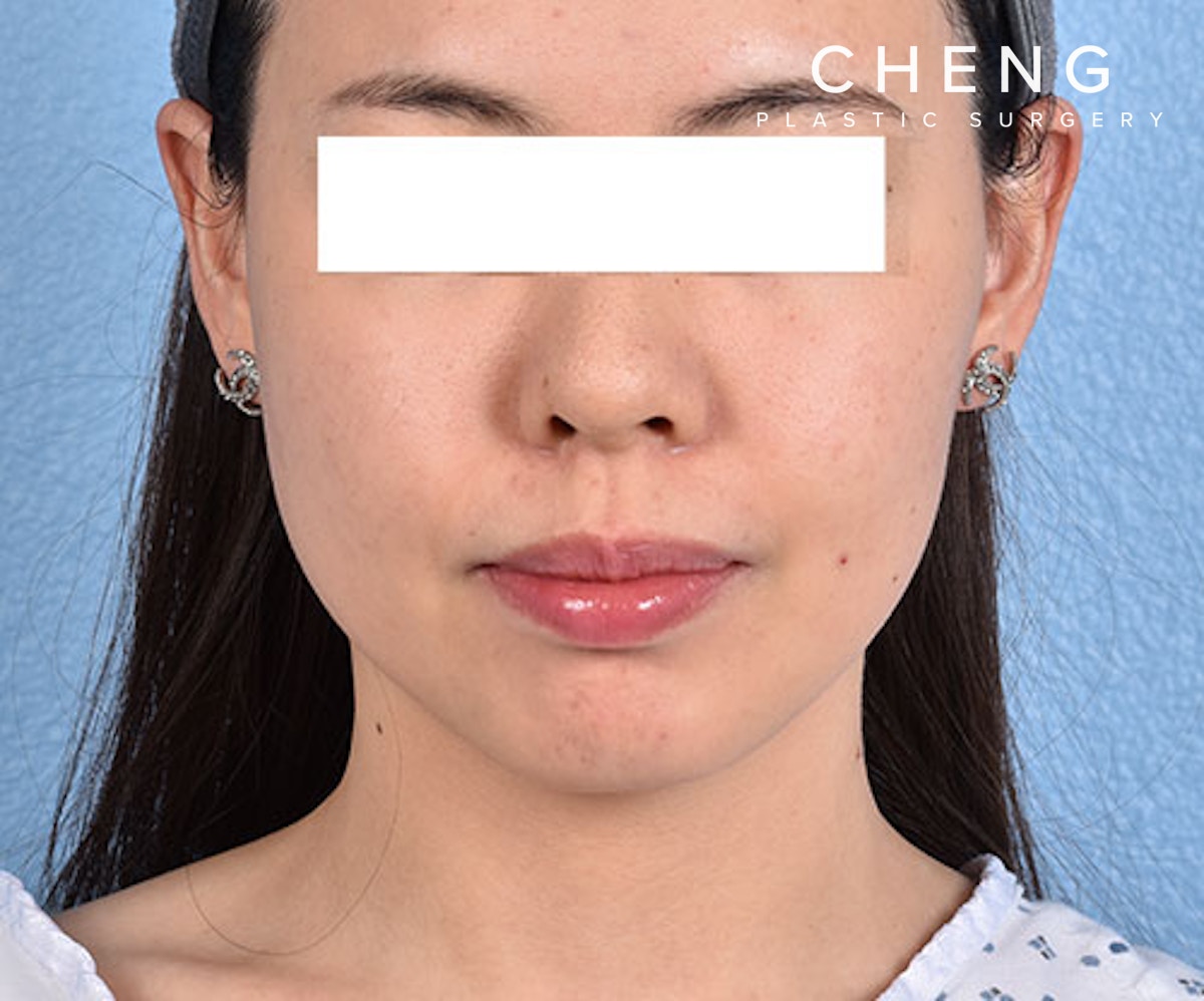 Thermage FLX  Before & After Gallery - Patient 163377 - Image 2