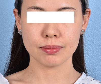 Thermage FLX  Before & After Gallery - Patient 163377 - Image 2