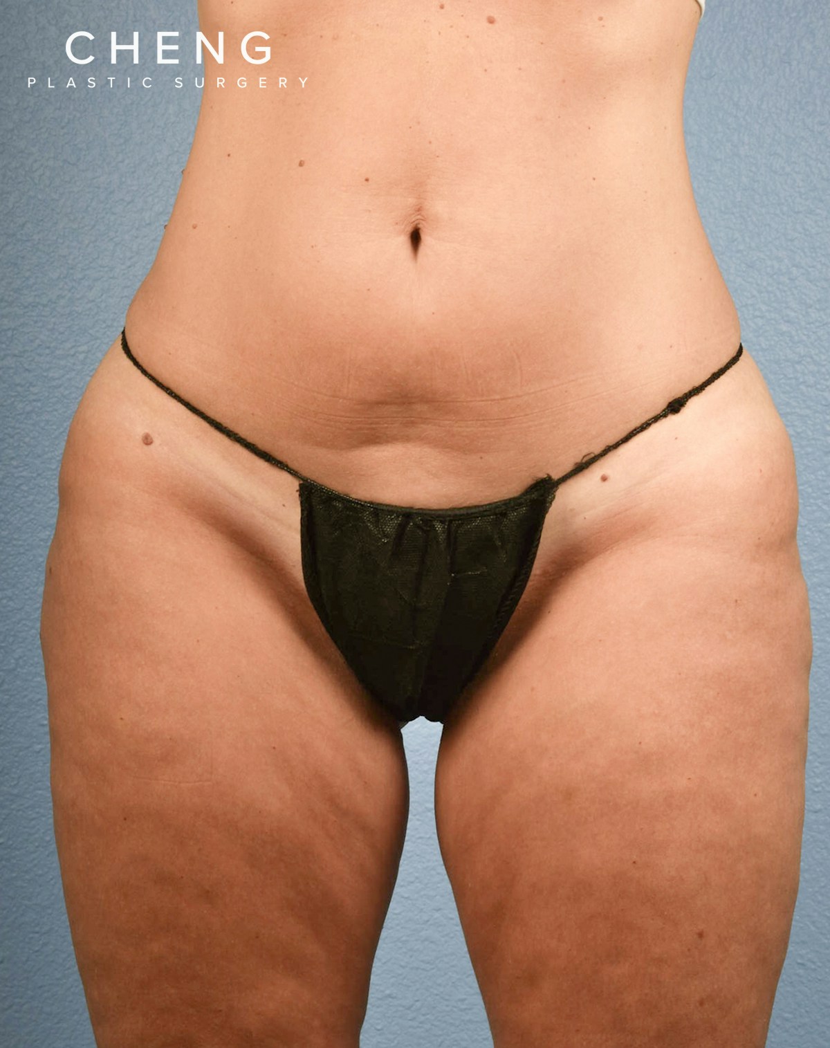CoolSculpting Before & After Gallery - Patient 100667 - Image 1