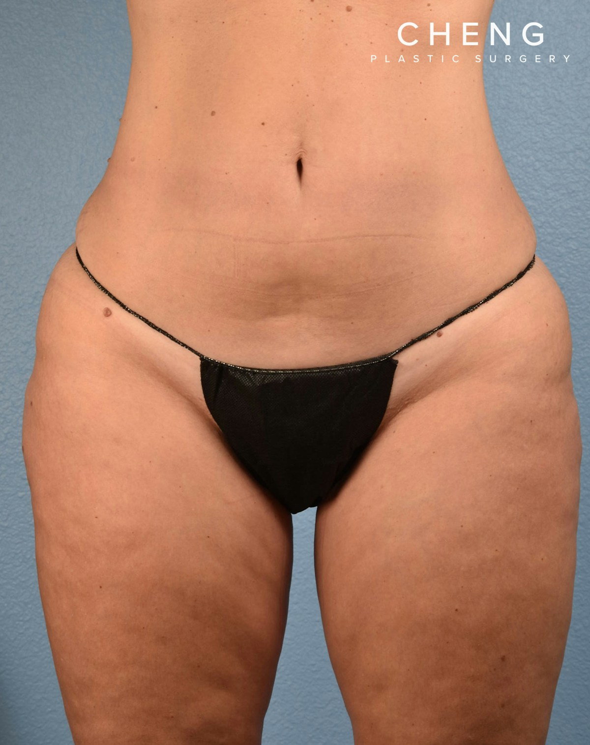 CoolSculpting Before & After Gallery - Patient 100667 - Image 2