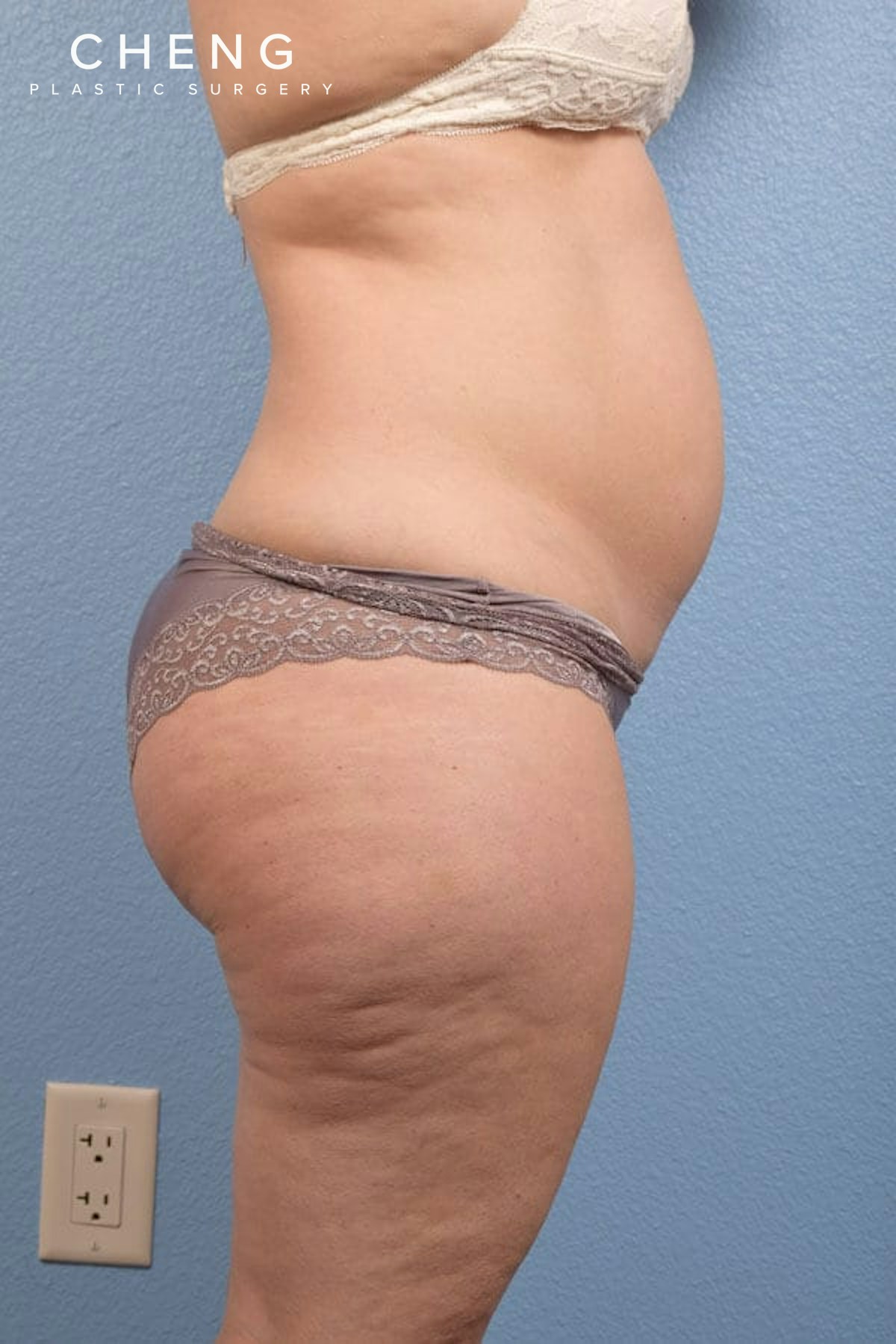 CoolSculpting Before & After Gallery - Patient 168019 - Image 1