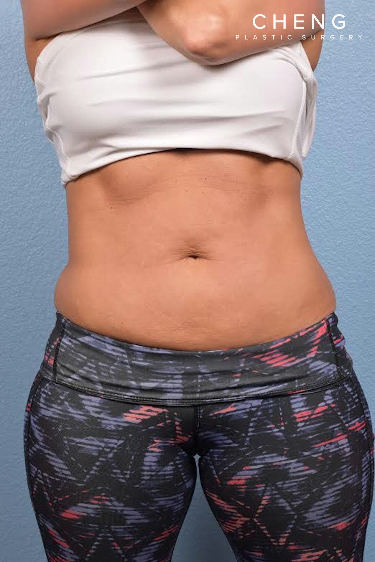 CoolSculpting Before & After Gallery - Patient 156566 - Image 4