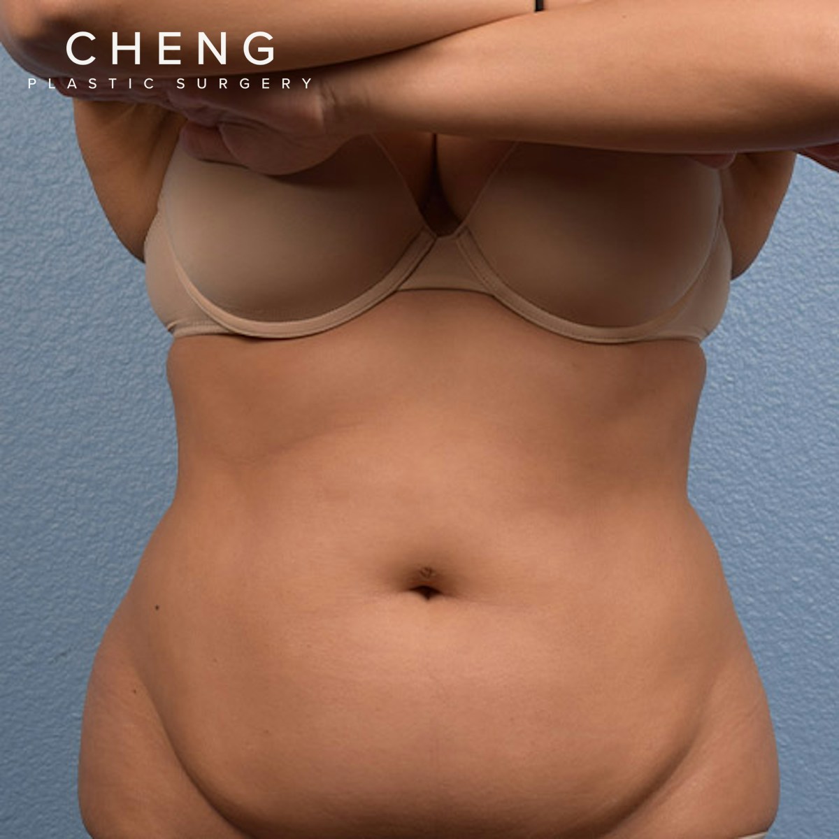 CoolSculpting Before & After Gallery - Patient 388152 - Image 1